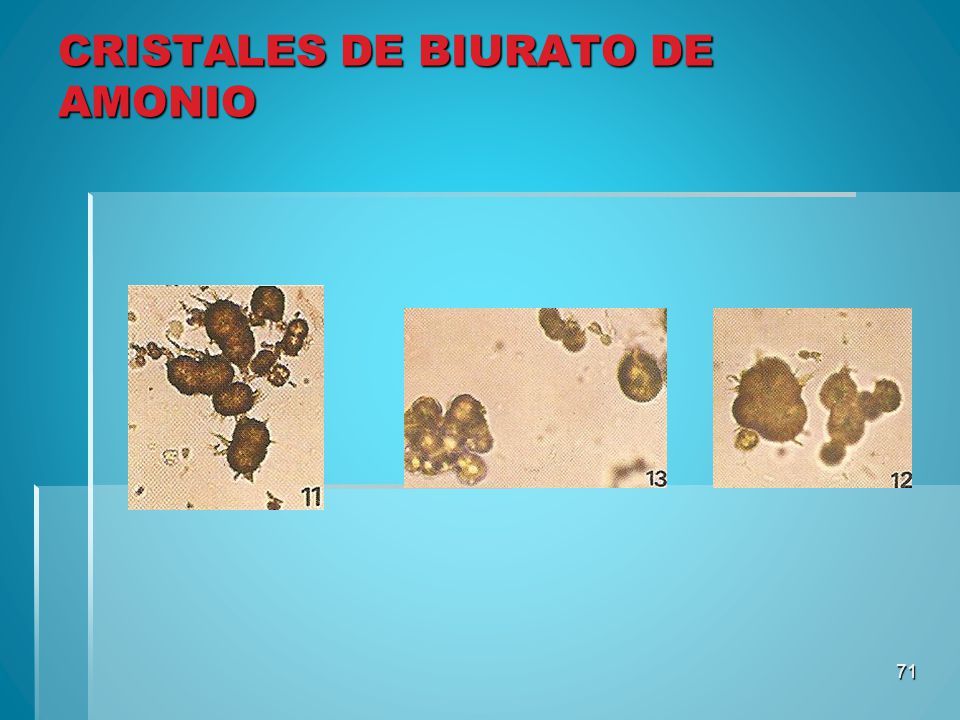 cristales de tirosina en heces cristales de tirosina en heces